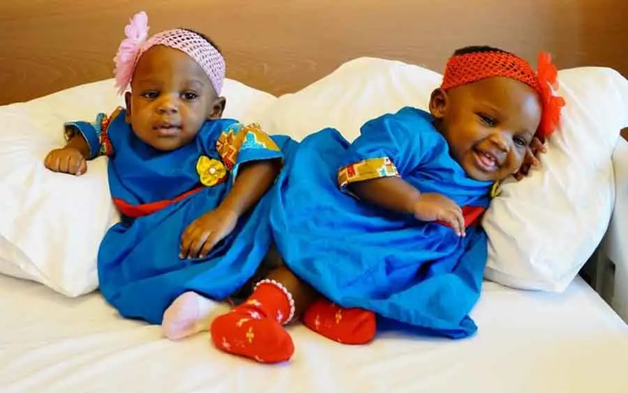 Turkish doctors successfully separate Cameroonian conjoined twins 